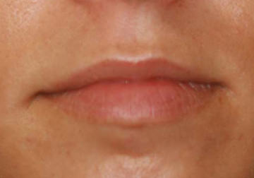  Lip enhancement