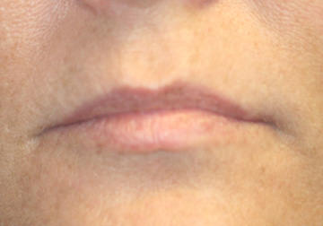  Lip enhancement