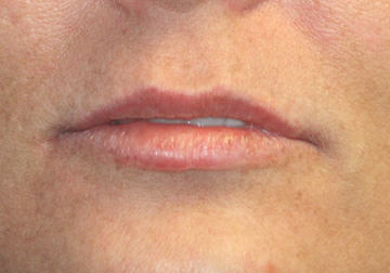  Lip enhancement