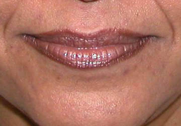  Lip enhancement