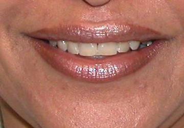  Lip enhancement