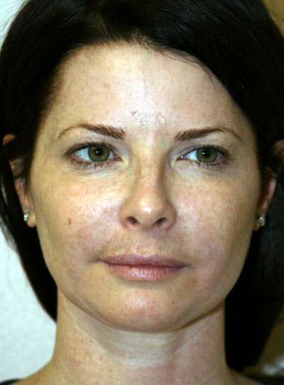 Cheek Augmentation