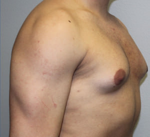 Gynecomastia (Male Breast Reduction)