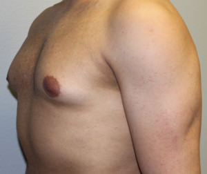 Gynecomastia (Male Breast Reduction)