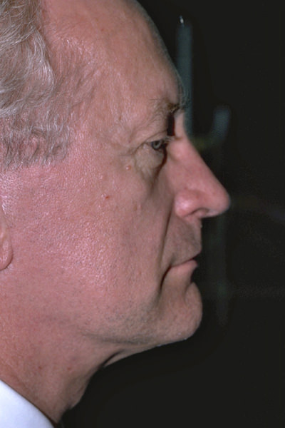 Male Forehead, Face and Neck Lifts