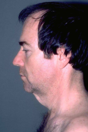 Male Forehead, Face and Neck Lifts