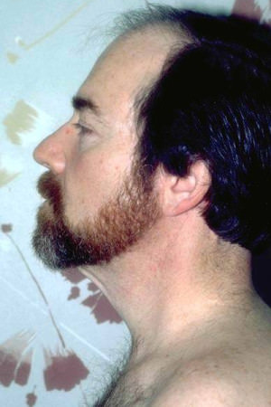 Male Forehead, Face and Neck Lifts