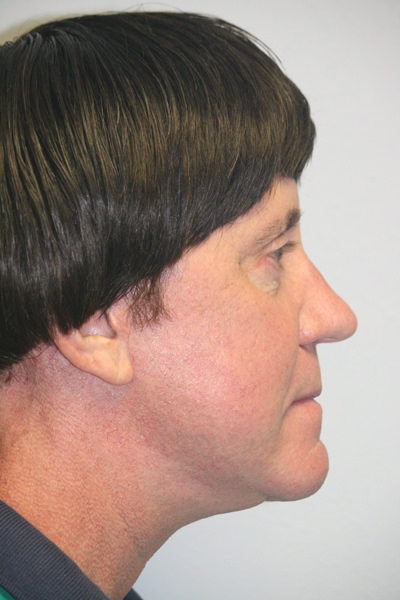 Male Forehead, Face and Neck Lifts