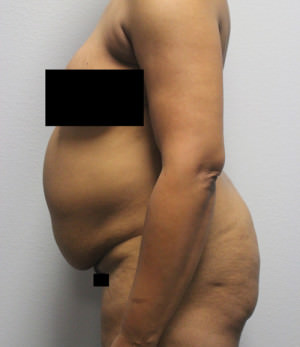 Tummy Tuck (Abdominoplasty)