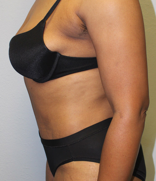 Tummy Tuck (Abdominoplasty)