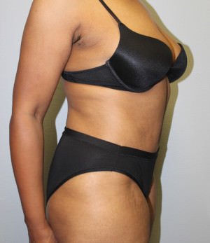 Tummy Tuck (Abdominoplasty)