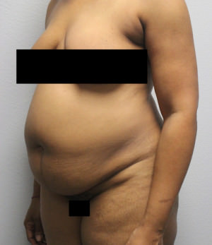 Tummy Tuck (Abdominoplasty)