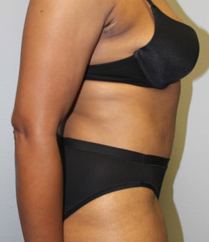 Tummy Tuck (Abdominoplasty)