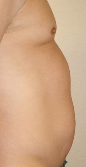 Male Liposuctions