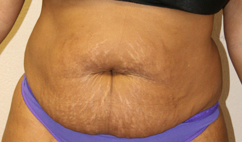 Tummy Tuck (Abdominoplasty)