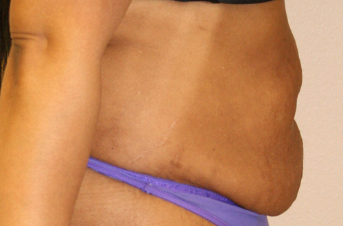 Tummy Tuck (Abdominoplasty)