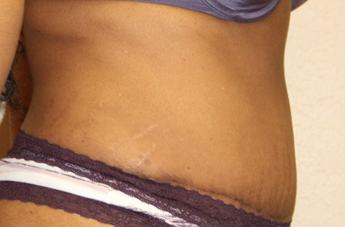 Tummy Tuck (Abdominoplasty)