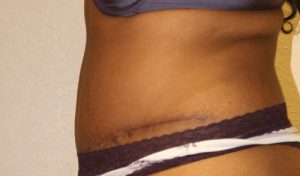 Tummy Tuck (Abdominoplasty)