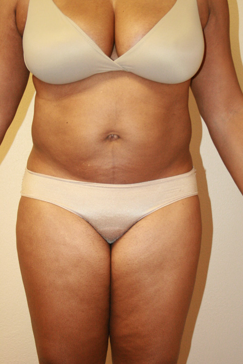 Tummy Tuck (Abdominoplasty)