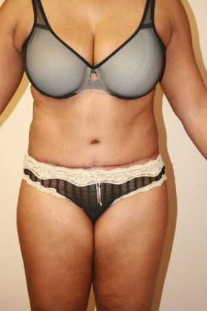 Tummy Tuck (Abdominoplasty)