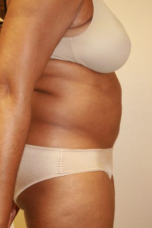 Tummy Tuck (Abdominoplasty)