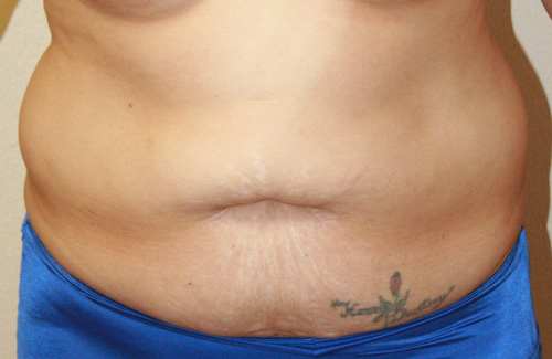 Tummy Tuck (Abdominoplasty)