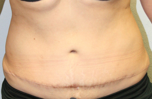 Tummy Tuck (Abdominoplasty)