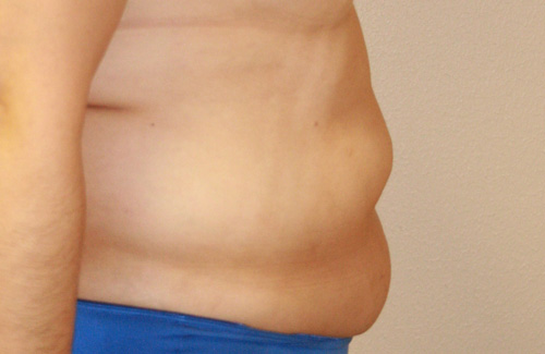 Tummy Tuck (Abdominoplasty)