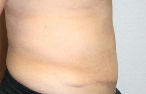 Tummy Tuck (Abdominoplasty)