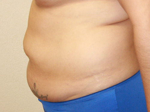 Tummy Tuck (Abdominoplasty)