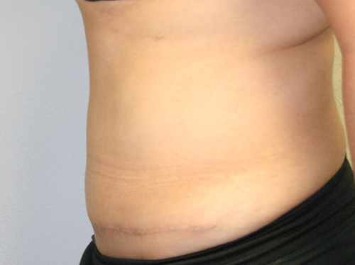 Tummy Tuck (Abdominoplasty)