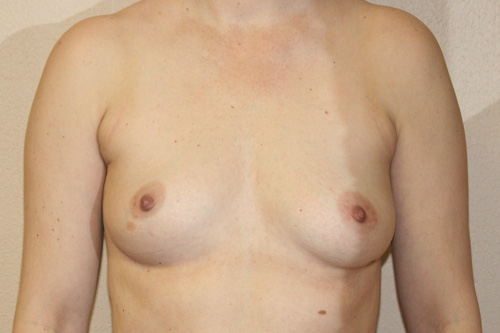 Breast Augmentation