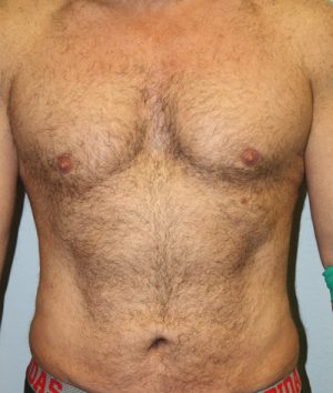 Male Liposuctions