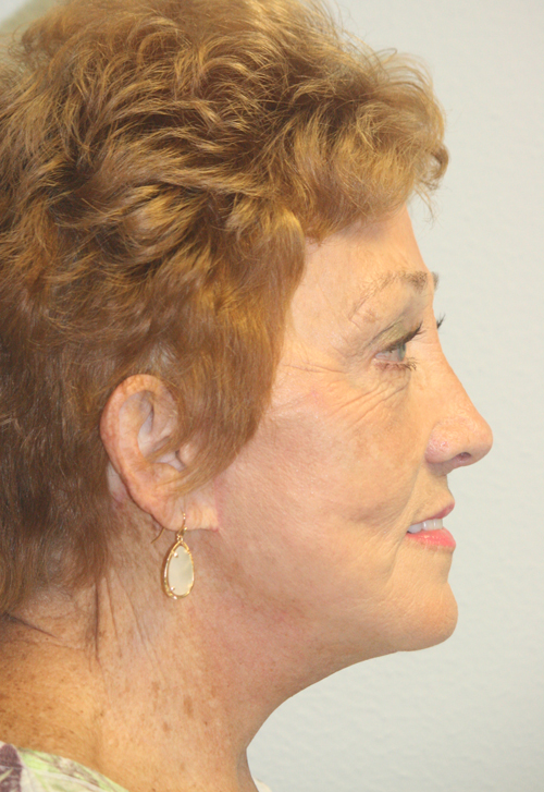 Forehead, Face and Neck Lift