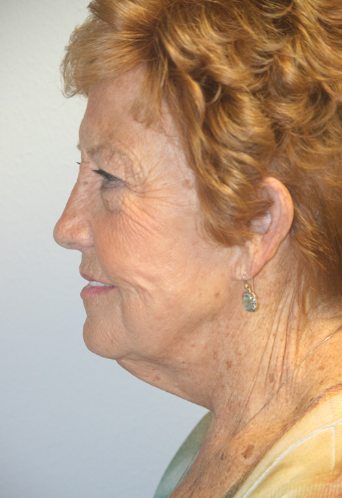 Forehead, Face and Neck Lift