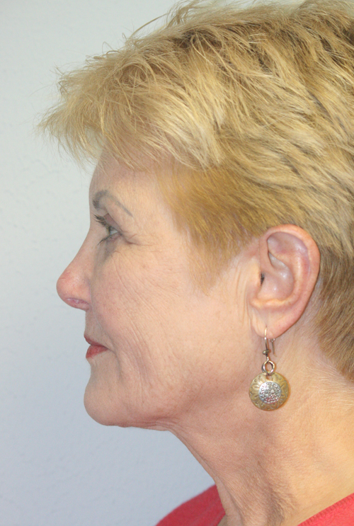 Forehead, Face and Neck Lift