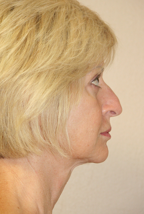 Forehead, Face and Neck Lift