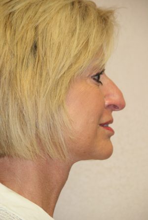 Forehead, Face and Neck Lift