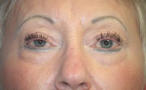  Eyelid Surgery (Blepheroplasty)