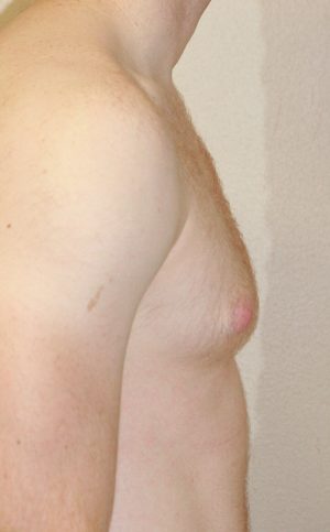 Gynecomastia (Male Breast Reduction) Case 7275 Before Photo Gynecomastia (Male Breast Reduction)