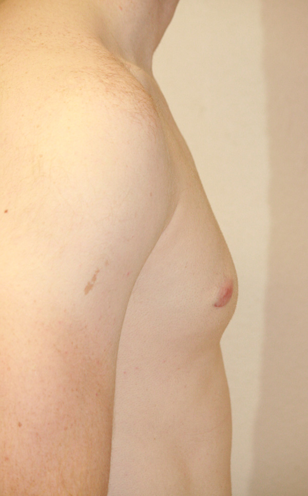 Gynecomastia (Male Breast Reduction)