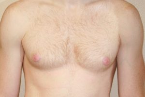 Gynecomastia (Male Breast Reduction) Case 7275 Before Photo Gynecomastia (Male Breast Reduction)