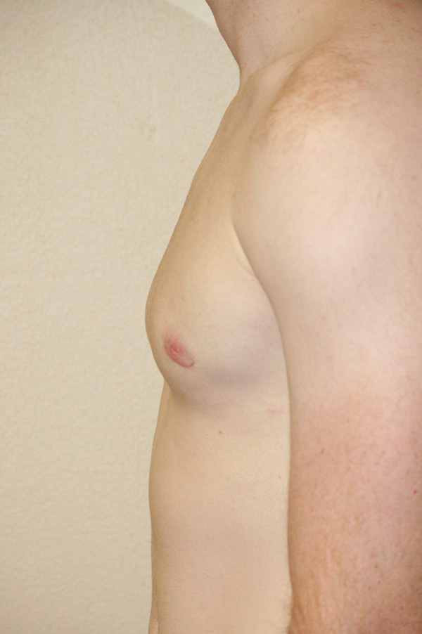 Gynecomastia (Male Breast Reduction)