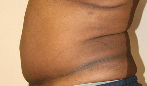 Tummy Tuck