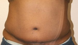 Tummy Tuck