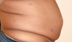 Tummy Tuck