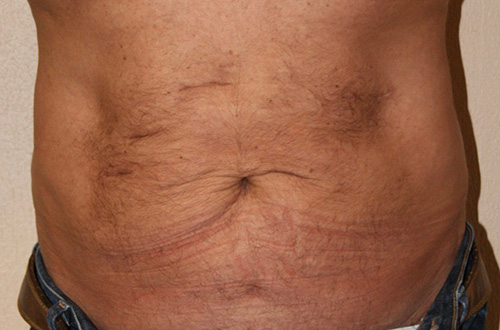 Tummy Tuck