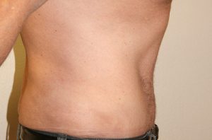 Tummy Tuck