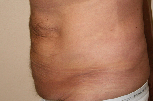 Tummy Tuck