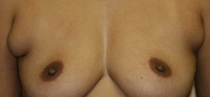 Liposuction of Axillary Rolls